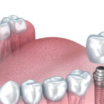 Dental Implants Modesto