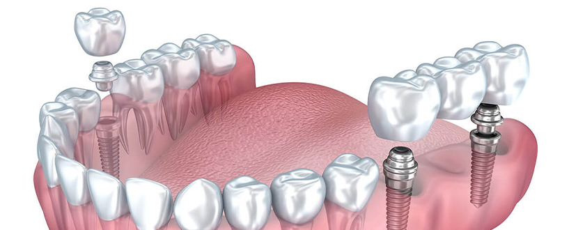 Dental Implants Modesto