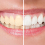 Teeth Whitening Modesto