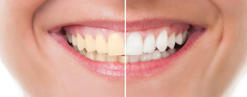 Professional Teeth Whitening | Dentist in Modesto