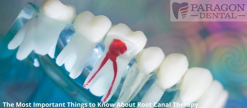 The Most Important Things to Know About Root Canal Therapy