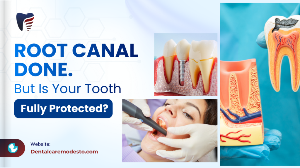 Dental Crowns After a Root Canal