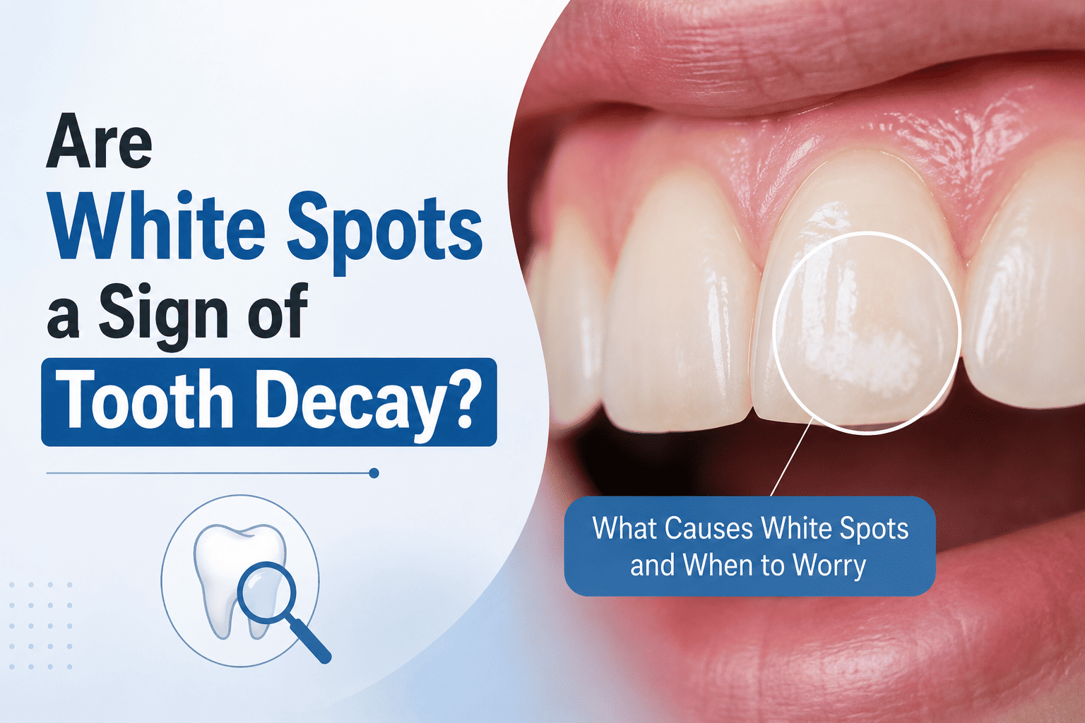Are White Spots a Sign of Tooth Decay? 