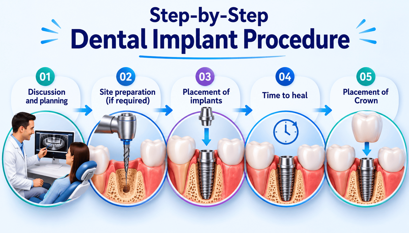 Step-by-Step Dental Implant Procedure
